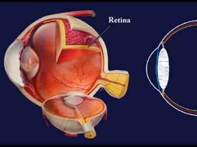 LA PREGUNTA ¿Qué es un desprendimiento de retina y cómo se trata?