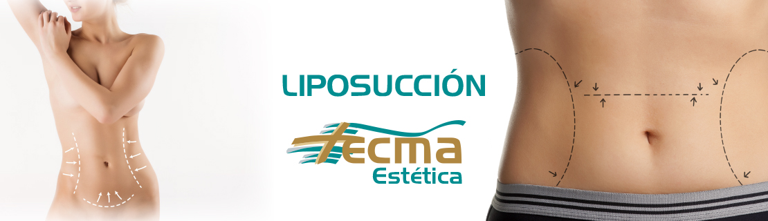 liposuccion