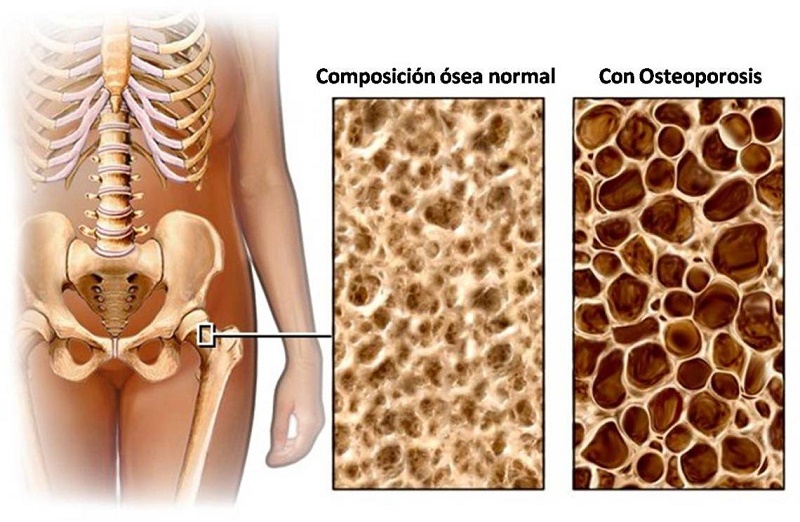 La densitometría hace frente a la osteoporosis