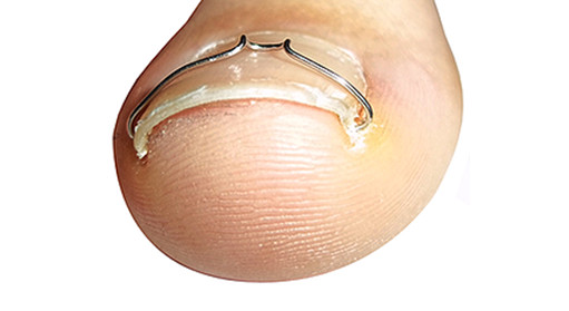 La ortonixia, técnica para evitar uñas encarnadas