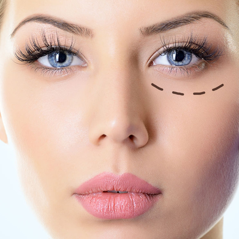 Blefaroplastia cirugía facial