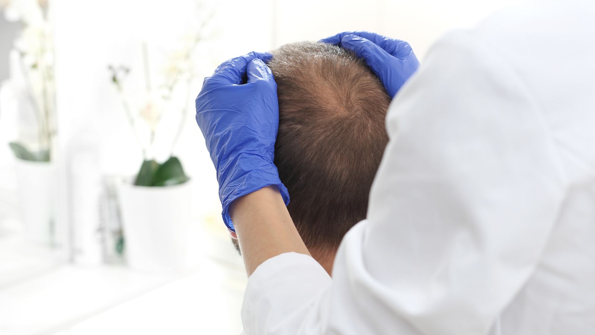 Alopecia, un problema común que trata la medicina estética