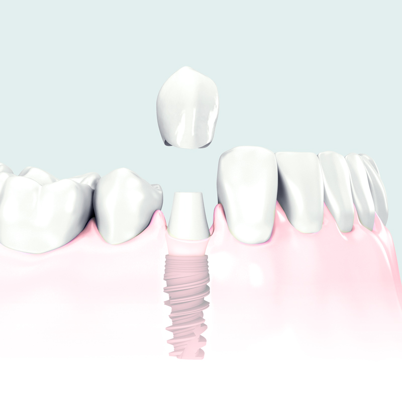 Implantología dental